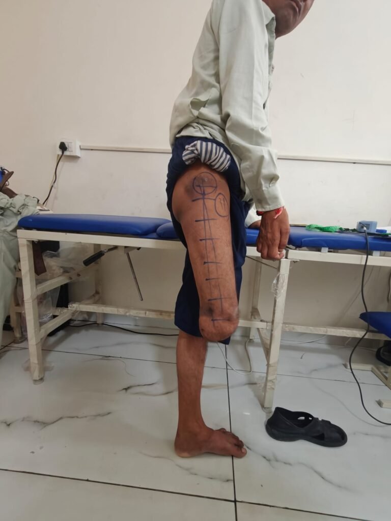 Free Artificial Limbs Measurement & Registration Camp